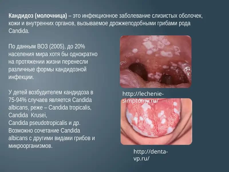 Кандидоз(молочница)