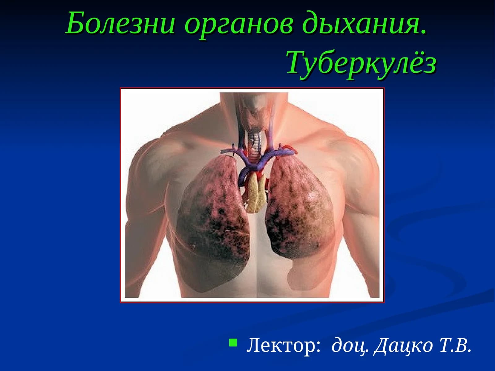 Острый бронхит (bronchitis acuta)
