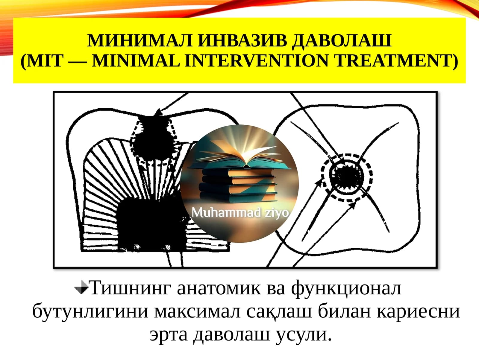 МИНИМАЛ ИНВАЗИВ ДАВОЛАШ(MIT—minimal interventiontreatment)