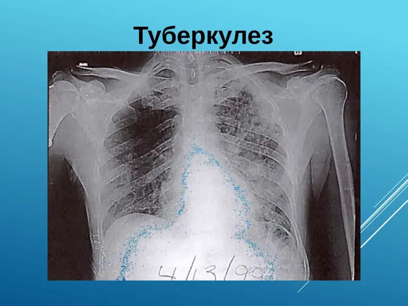Туберкулез
