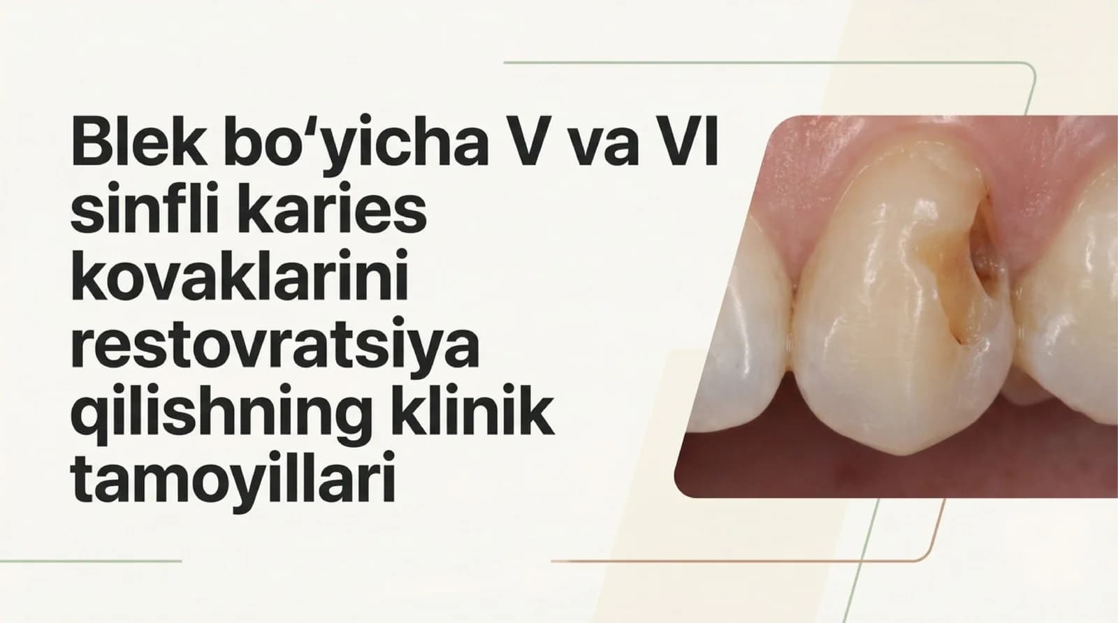 Blek boʻyicha V , VI sinfli karies kovaklarini restovratsiya qilishning klinik tamoyillari