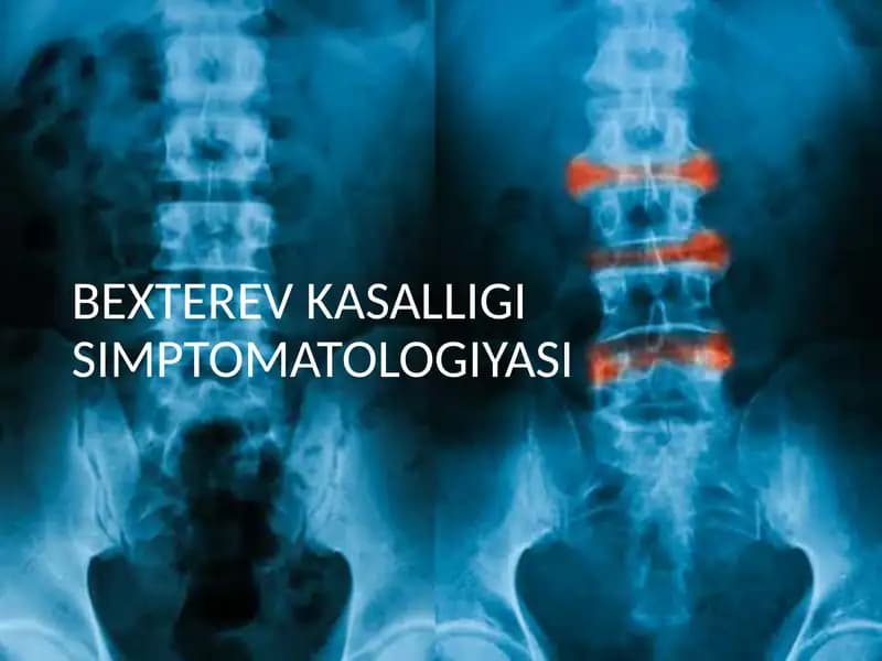Bexterev kasalligi