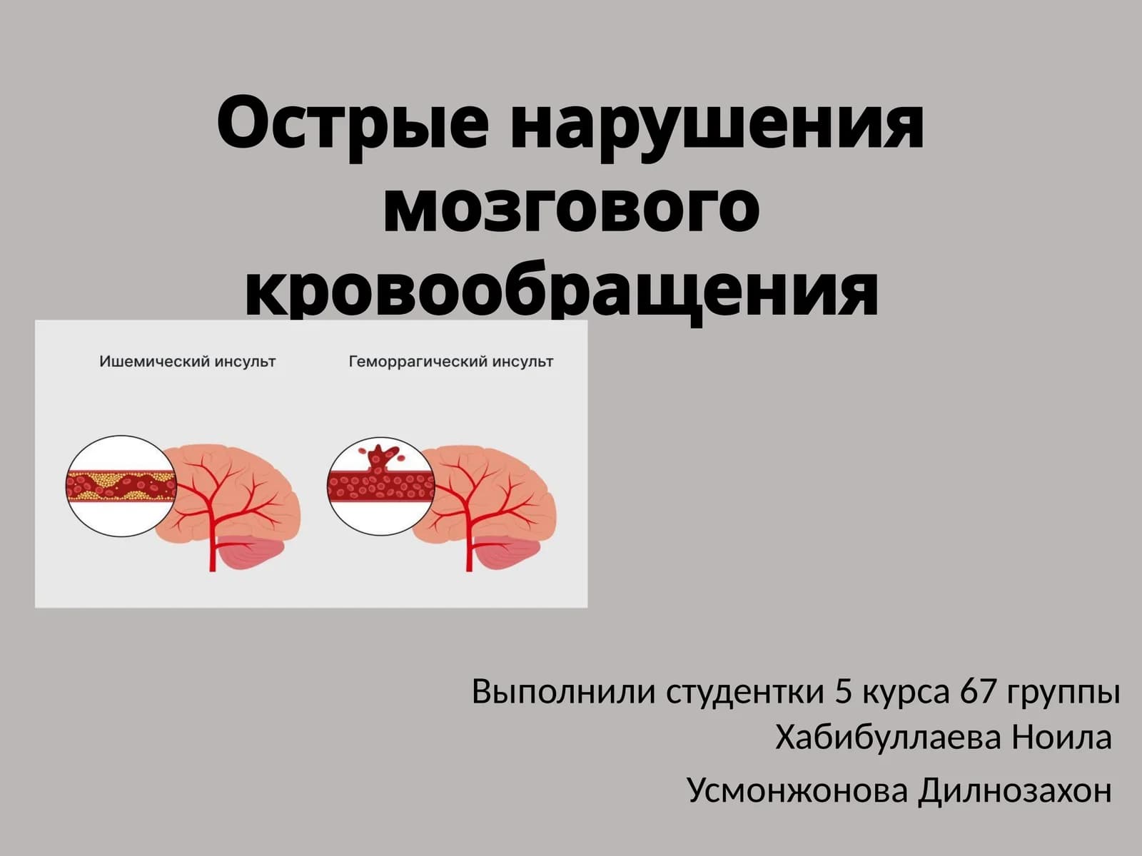 Острые нарушения мозгового кровообращения