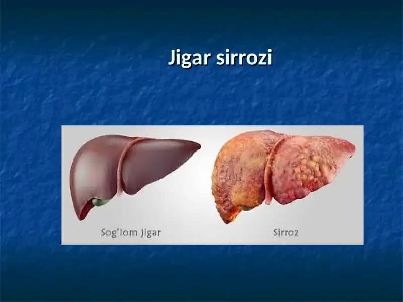 Jigar sirrozi