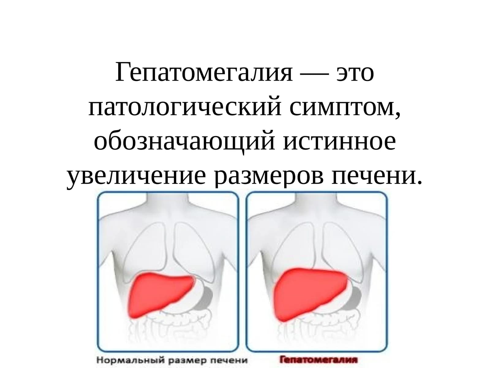Гепатомегалия — это патологический симптом, обозначающий истинное увеличение размеров печени.