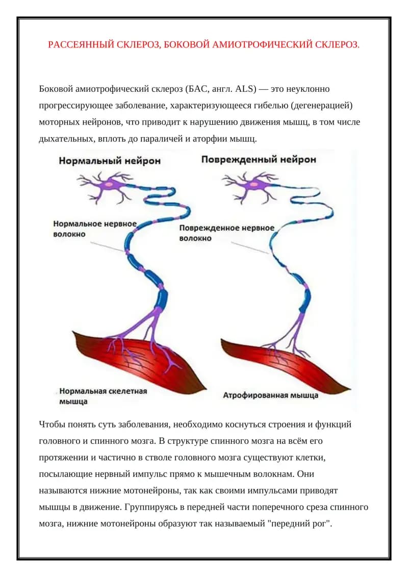 Боковой амиотрофический склероз(БАС)