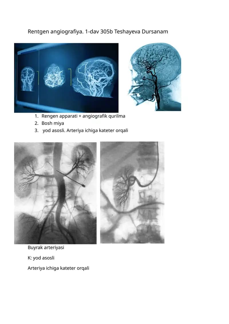 Rentgen angiografiya