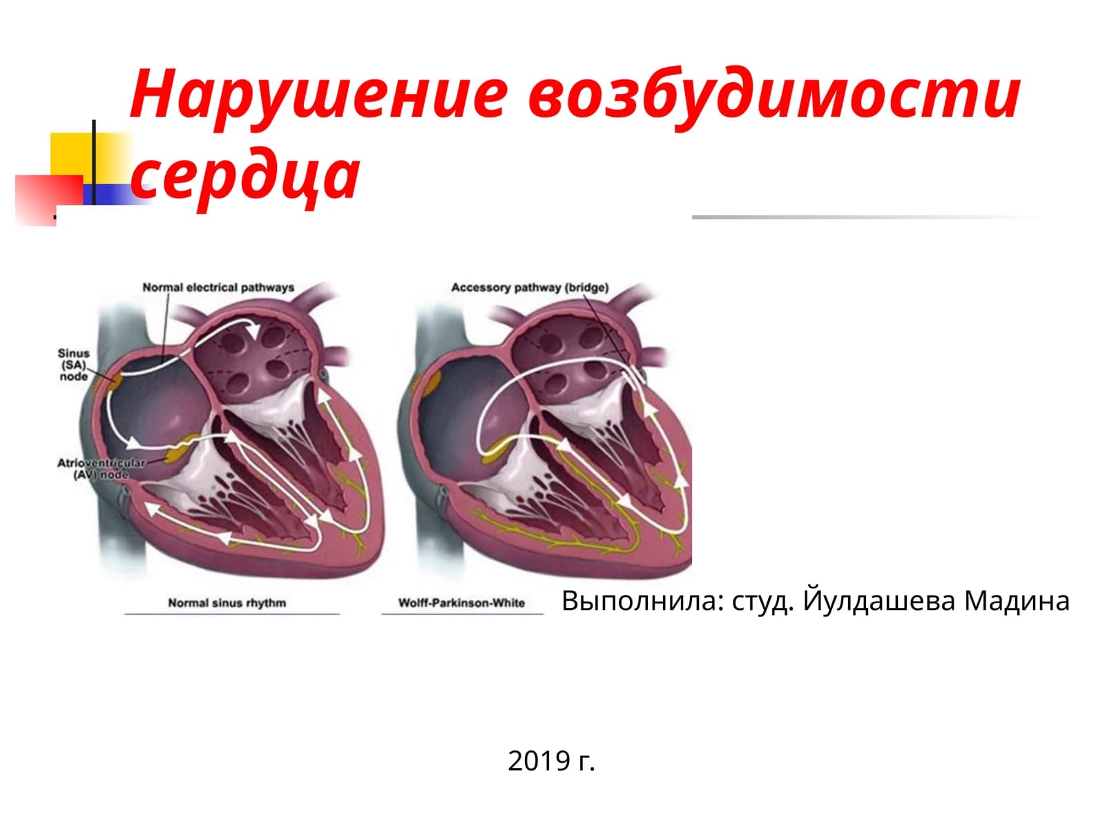 Нарушение возбудимости сердца
