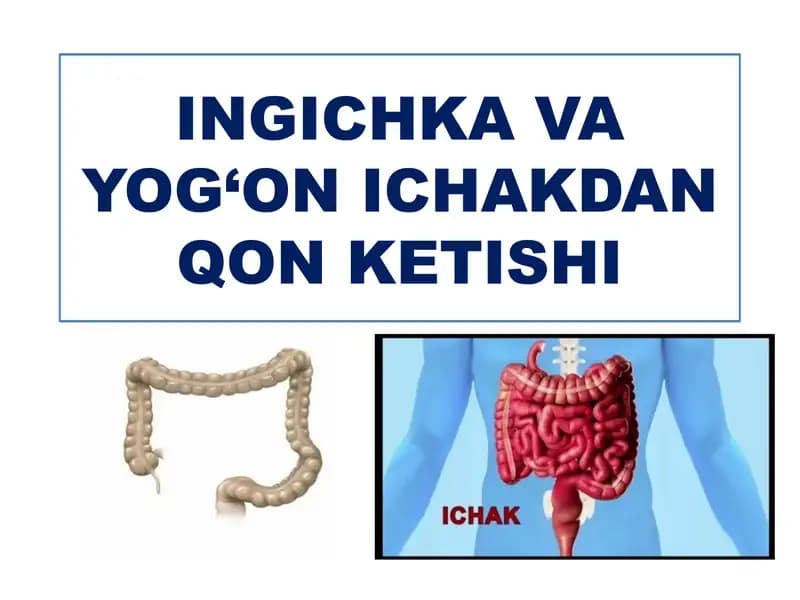 Ichakdan qon ketishi