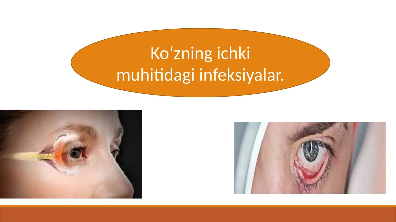 Ko‘zning ichki muhitidagi infeksiyalar.