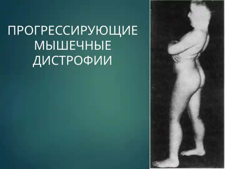 Прогрессирующие мышечные дистрофии