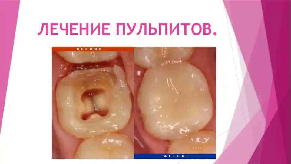 Лечение пульпитов