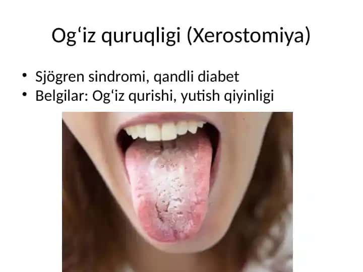 Og‘iz quruqligi (Xerostomiya)