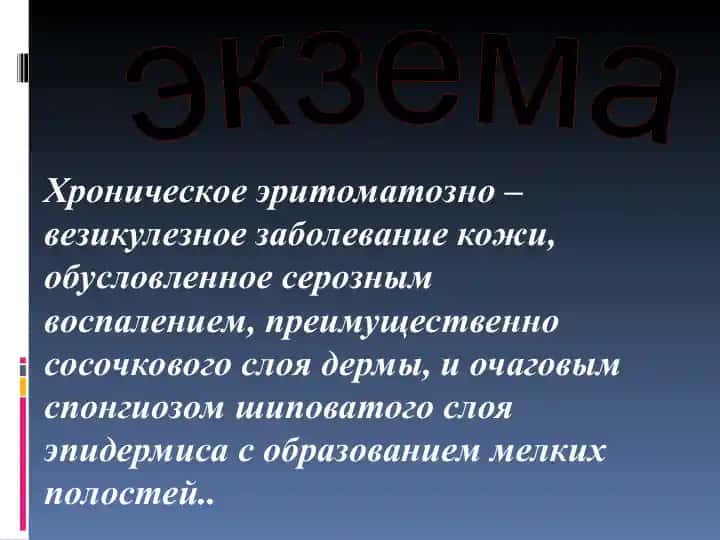 Экзема
