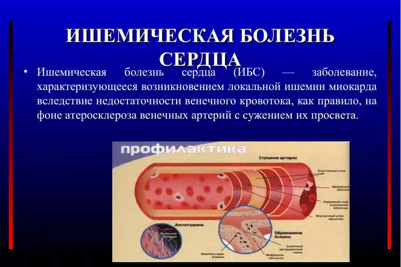 Ишемическая болезнь сердца