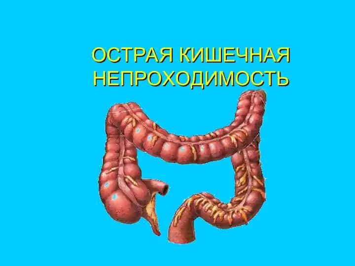 Острый кишечная непроходимость