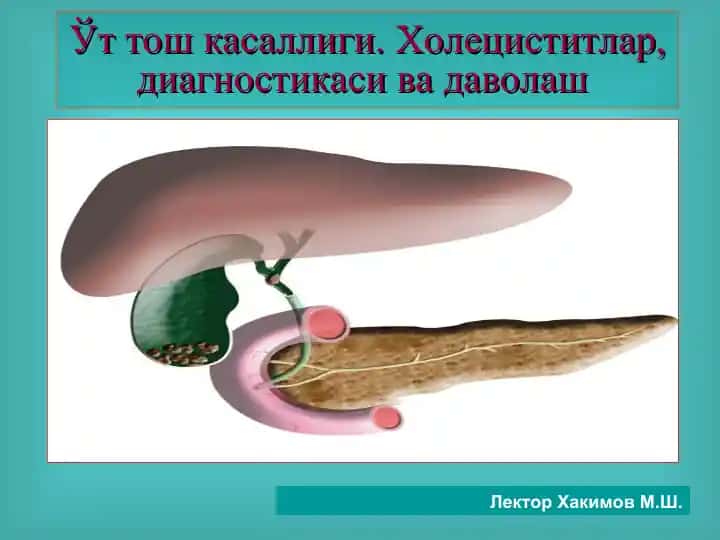 Ўт тош касаллиги.Холециститлар, диагностикаси ва даволаш