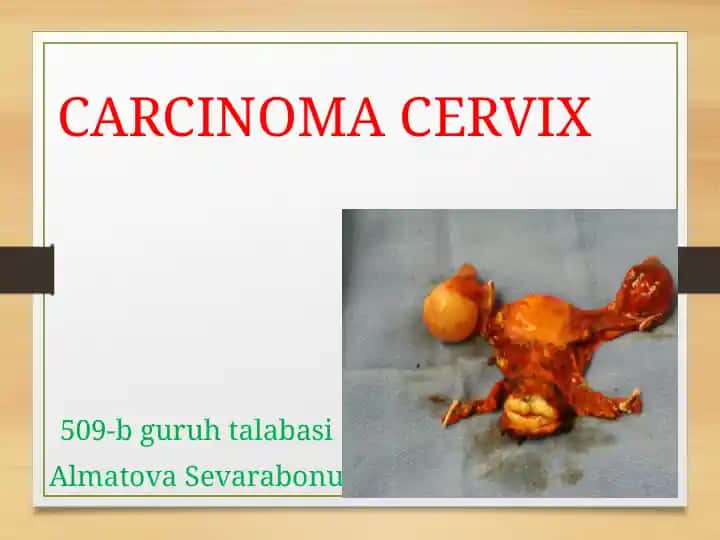 CARCINOMA CERVIX