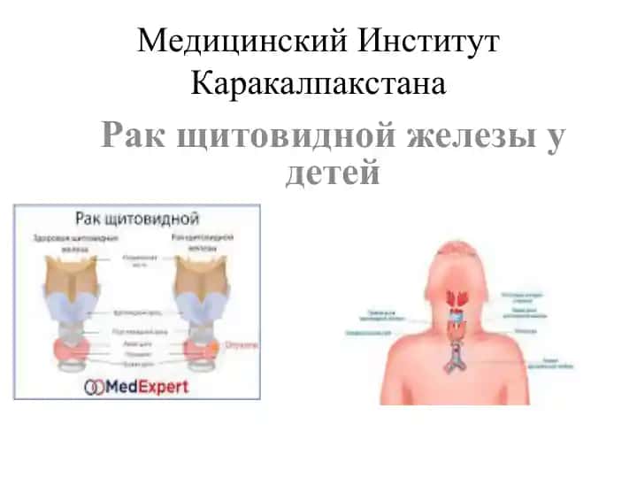 Рак щитовидной железы у детей