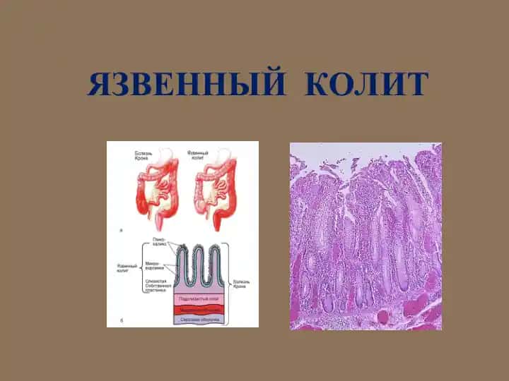 НЕСПЕЦИФИЧЕСКИЙ ЯЗВЕННЫЙ КОЛИТ