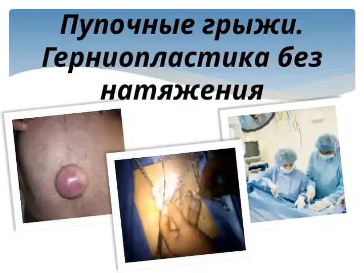 Пупочные грыжи. Герниопластика без натяжения