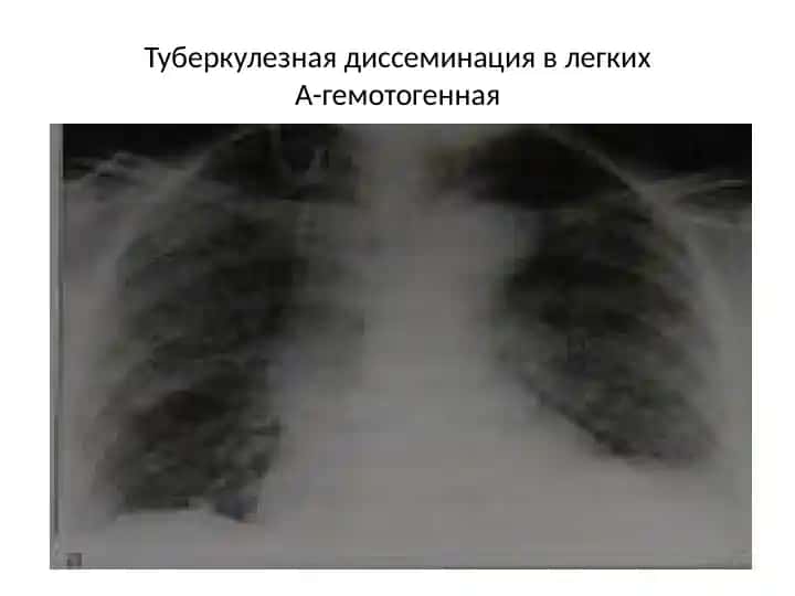 Туберкулез