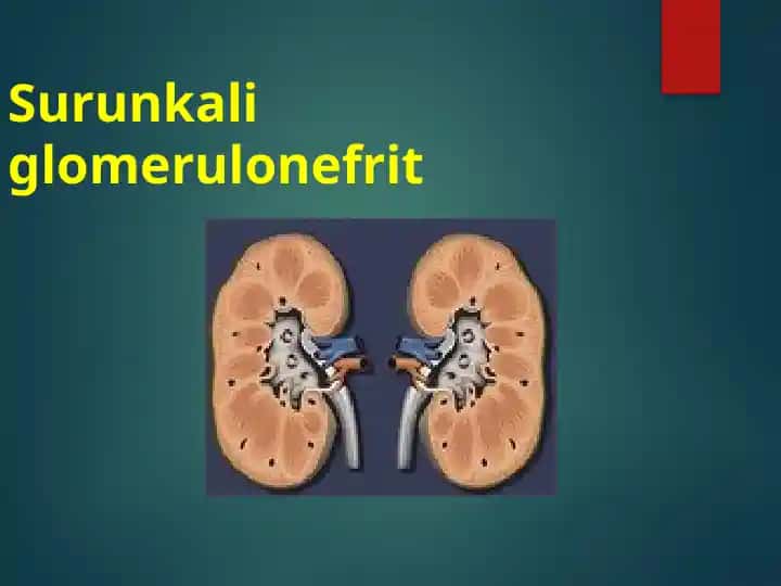 Surunkali glomerulonefrit