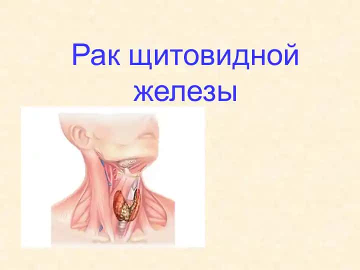 Рак щитовидной железы