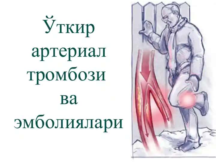 Ўткир артериал тромбозива эмболиялари