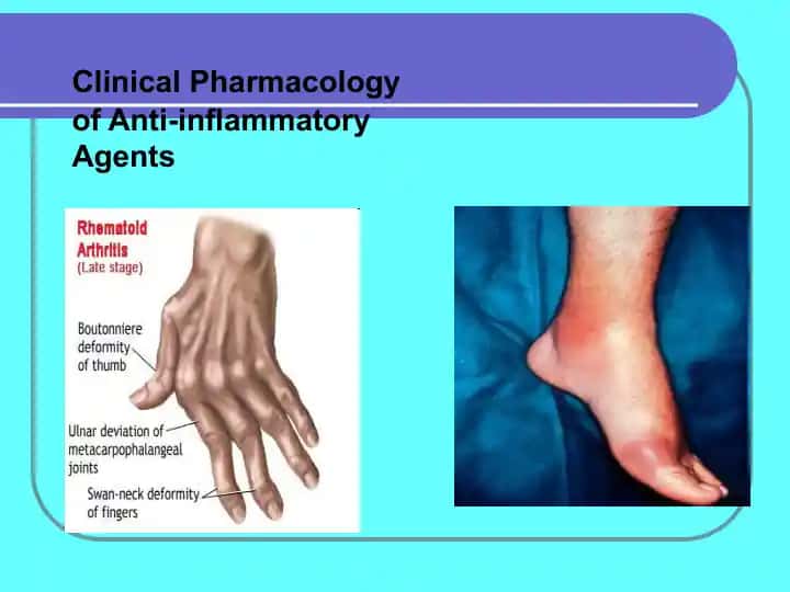 Clinical Pharmacology of Anti-inflammatory Agents (Rheumatic Diseases)