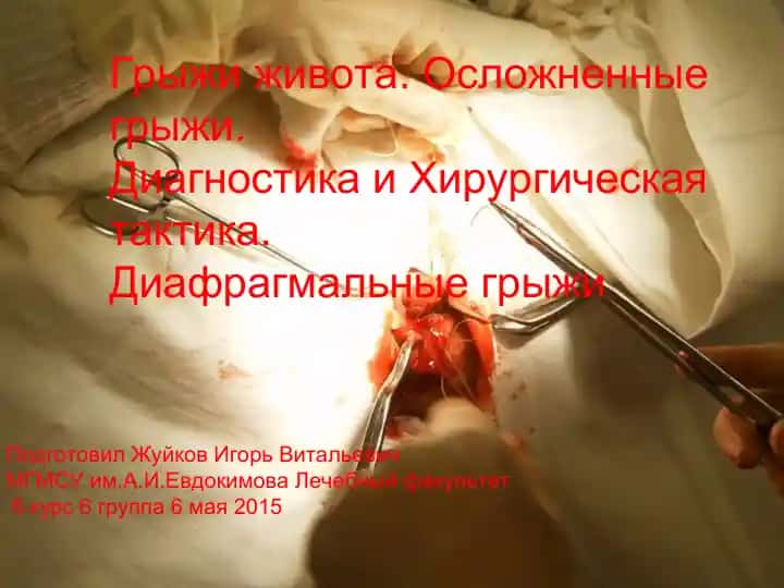 Грыжи живота. Осложненные грыжи.
