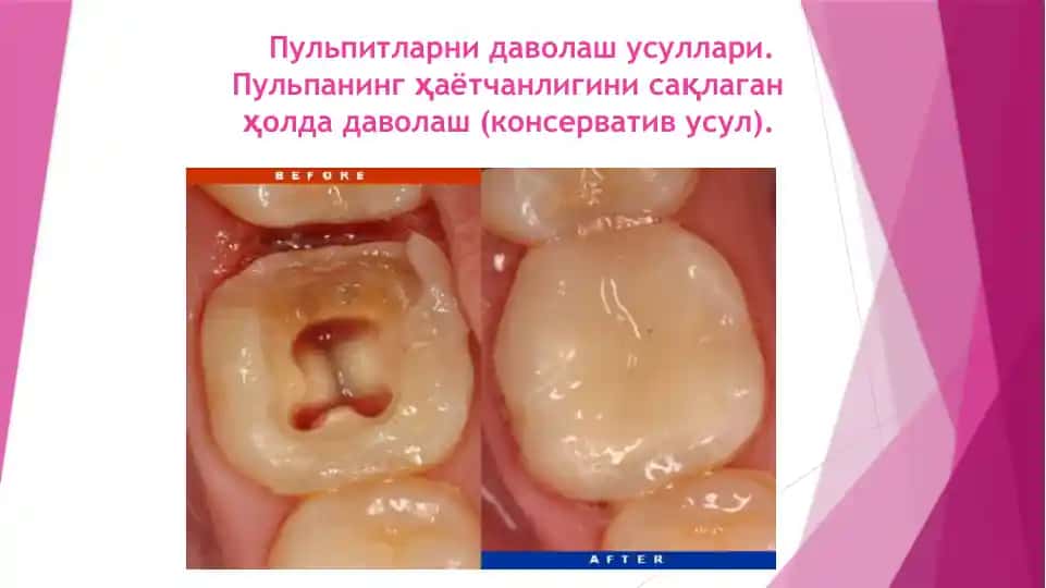 Пульпитларни даволаш усуллари