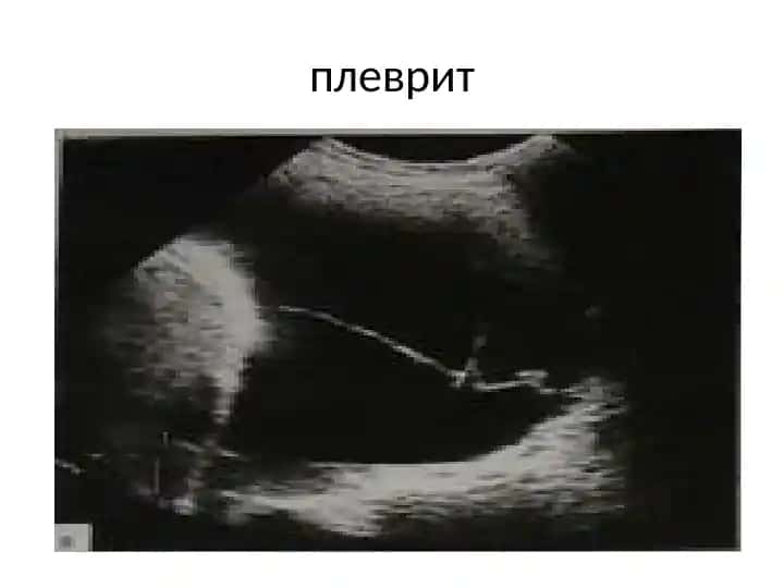 плеврит