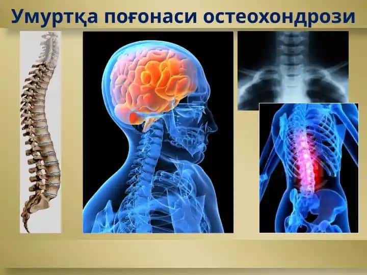 Умуртқа поғонаси остеохондрози