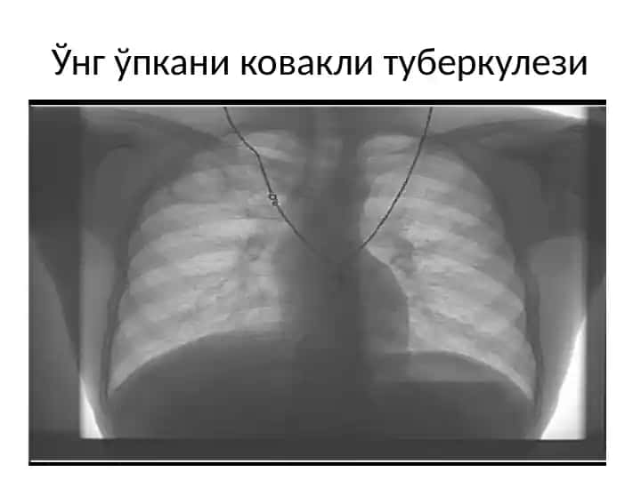 Ўнг ўпкани ковакли туберкулези