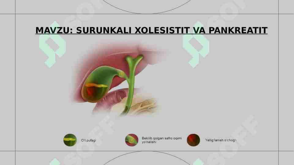 SURUNKALI XOLESISTIT VA PANKREATIT