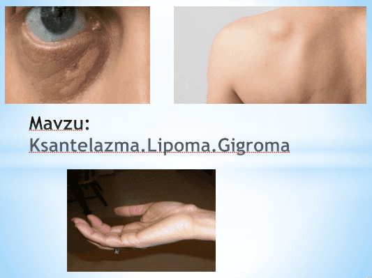 Ksantelazma.Lipoma.Gigromappt