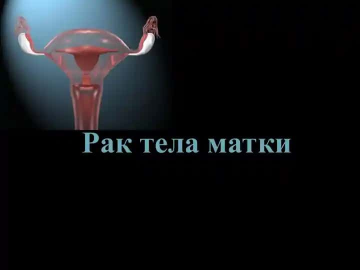 Рак тела матки