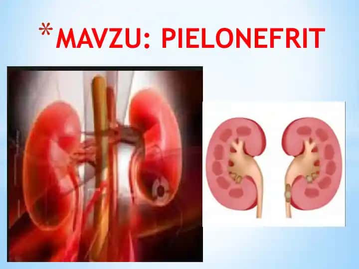 PIELONEFRIT