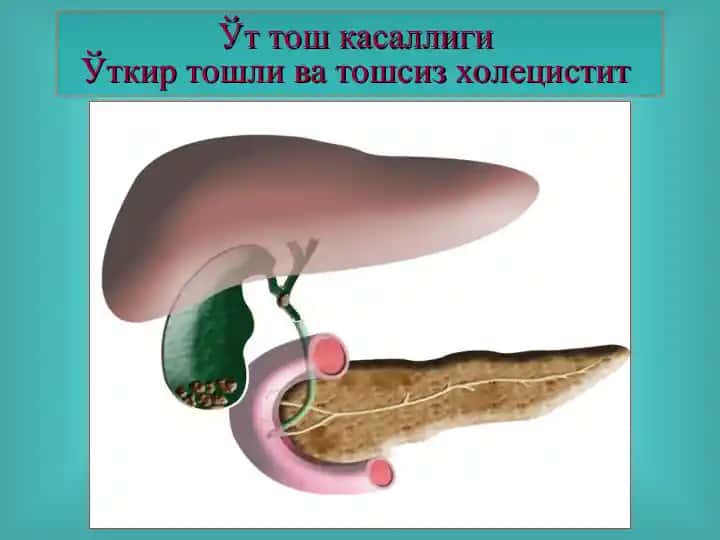 Ўт тош касаллиги
