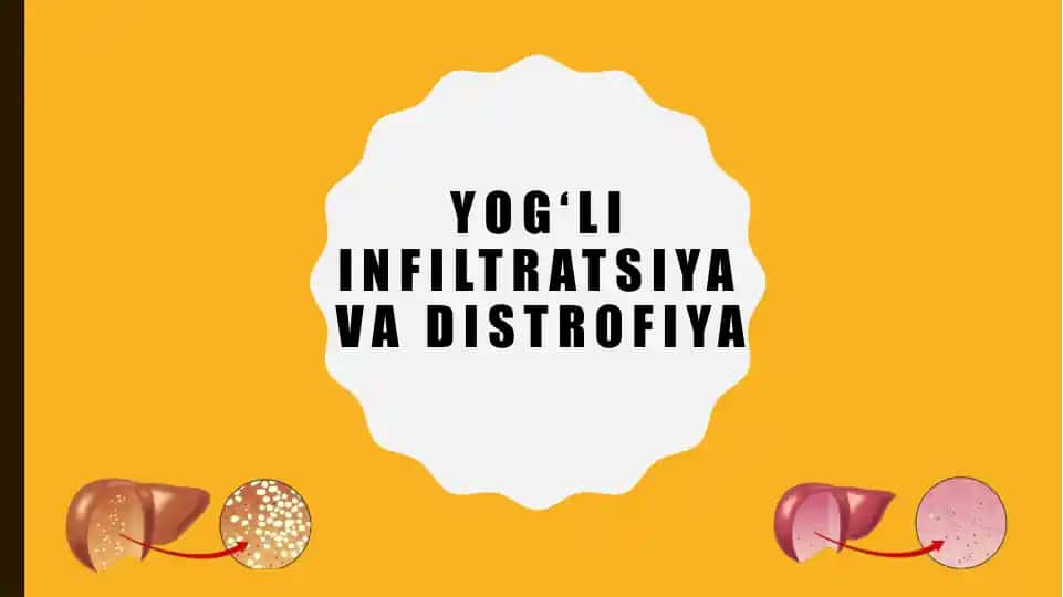 Distofiya