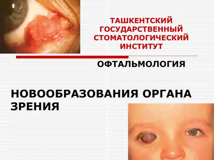 Опухоли органа зрения
