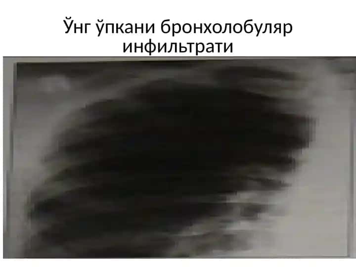 Ўнг ўпкани бронхолобуляринфильтрати