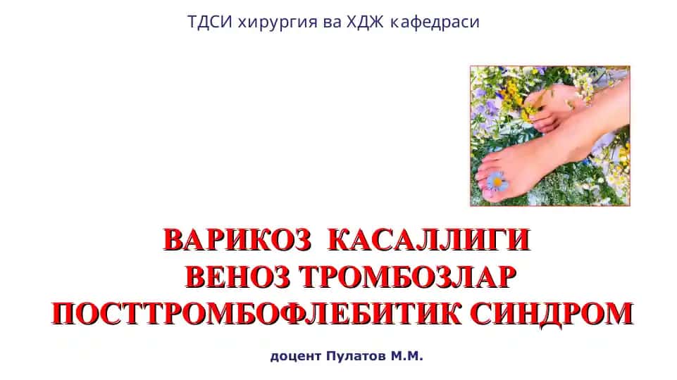 ВАРИКОЗ КАСАЛЛИГИ