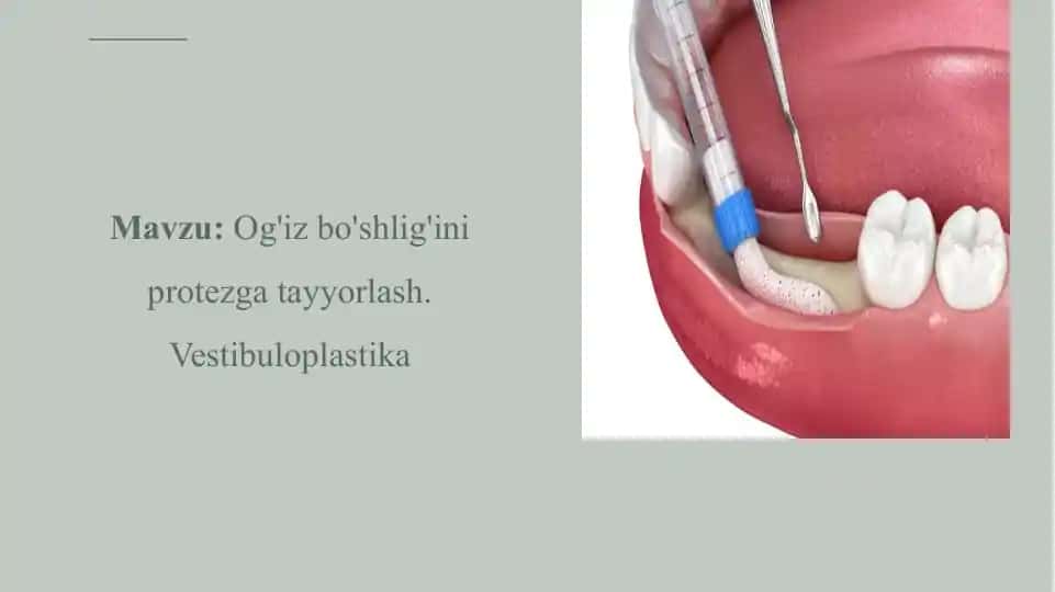 Vestibuloplastika