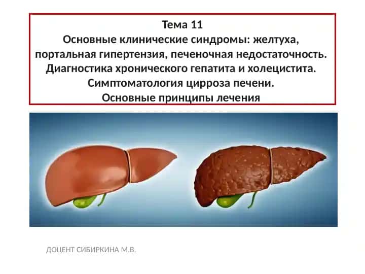 Желтуха (Icterus)