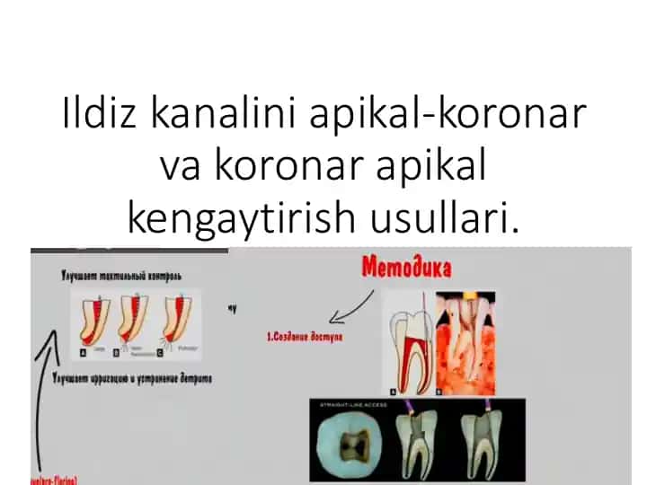 Ildiz kanalini apikal-koronar va koronar apikal kengaytirish usullari