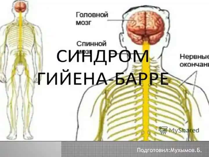Синдром Гийена-Барре