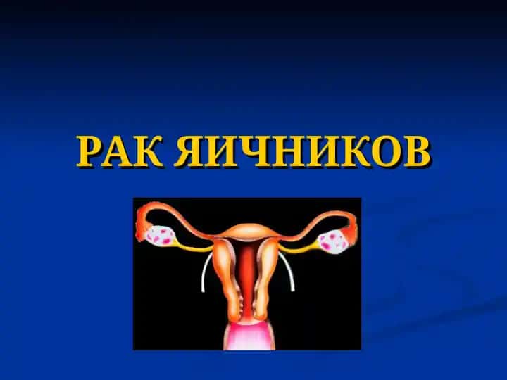 Рак Яичников