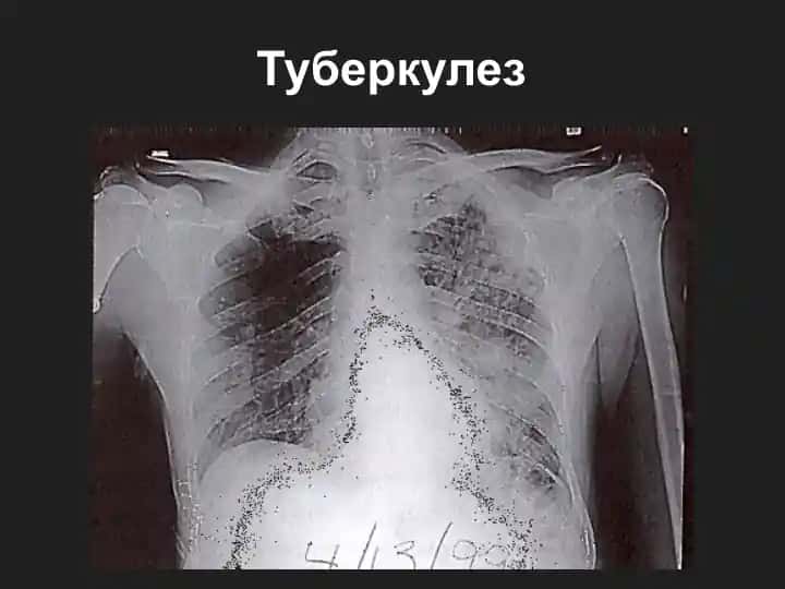 Туберкулез